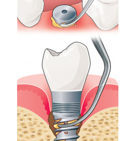 Ултразвуков накрайник IP1