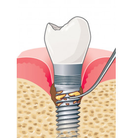 Ултразвуков накрайник IP2L