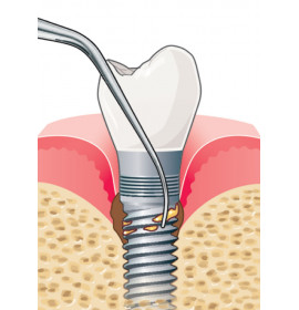Ултразвуков накрайник IP2R